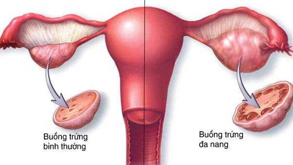 NHỮNG BỆNH LÝ DẪN TỚI RA MÁU GIỮA CHU KỲ KINH