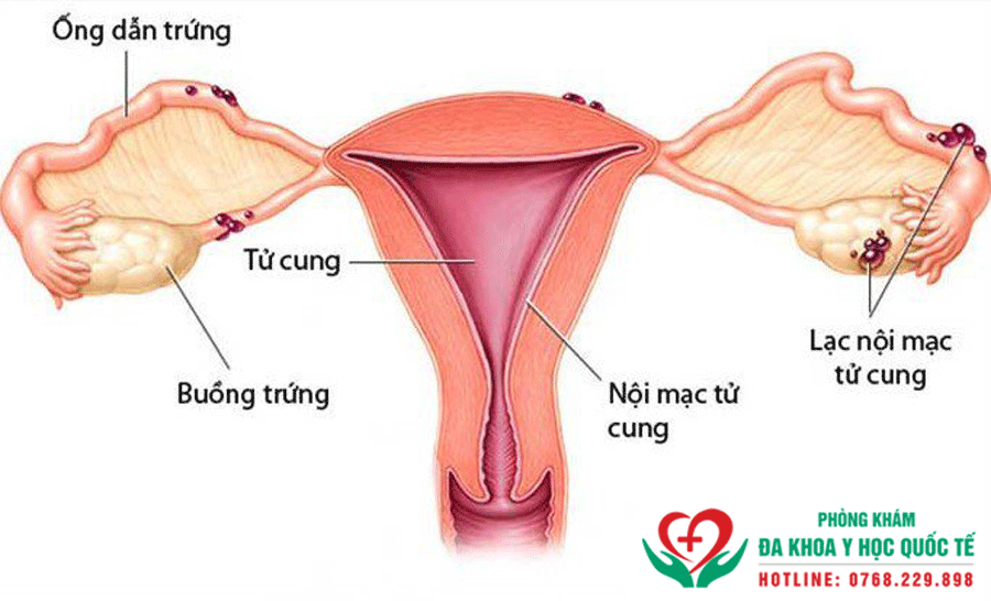 Lạc nội mạc tử cung