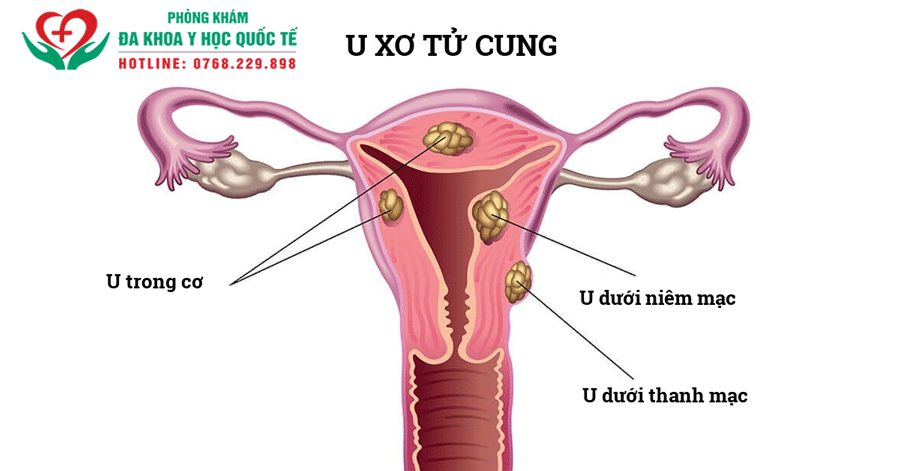 KINH NGUYỆT MÀU ĐEN - BIỂU HIỆN CỦA BỆNH PHỤ KHOA NGUY HIỂM