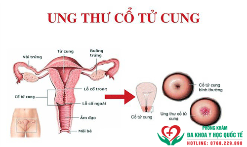 Những biến chứng viêm âm đạo do nấm thường gặp